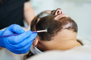 Chemical Peels for Acne: Can They Help?
